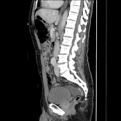 Closed loop small bowel obstruction - omental adhesion causing "internal hernia" (Radiopaedia 85129-100682 C 91).jpg