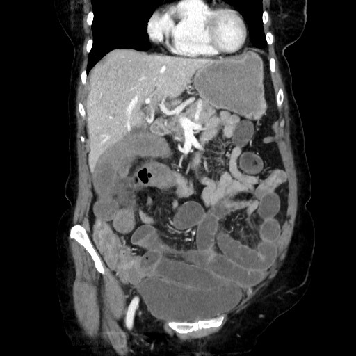 Closed loop small bowel obstruction due to adhesive band, with intramural hemorrhage and ischemia (Radiopaedia 83831-99017 C 45).jpg