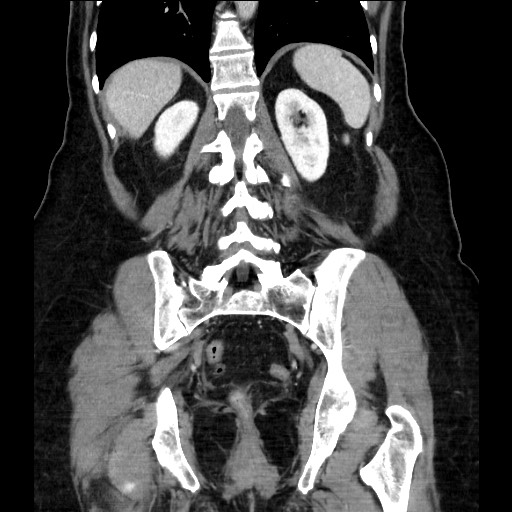 Closed loop small bowel obstruction due to adhesive bands - early and late images (Radiopaedia 83830-99014 B 91).jpg