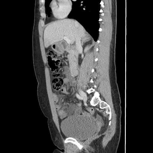 Closed loop small bowel obstruction due to trans-omental herniation (Radiopaedia 35593-37109 C 28).jpg