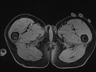 Closed loop small bowel obstruction in pregnancy (MRI) (Radiopaedia 87637-104031 G 44).jpg