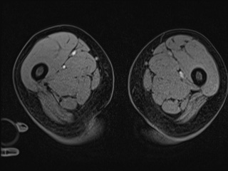 Closed loop small bowel obstruction in pregnancy (MRI) (Radiopaedia 87637-104031 G 59).jpg