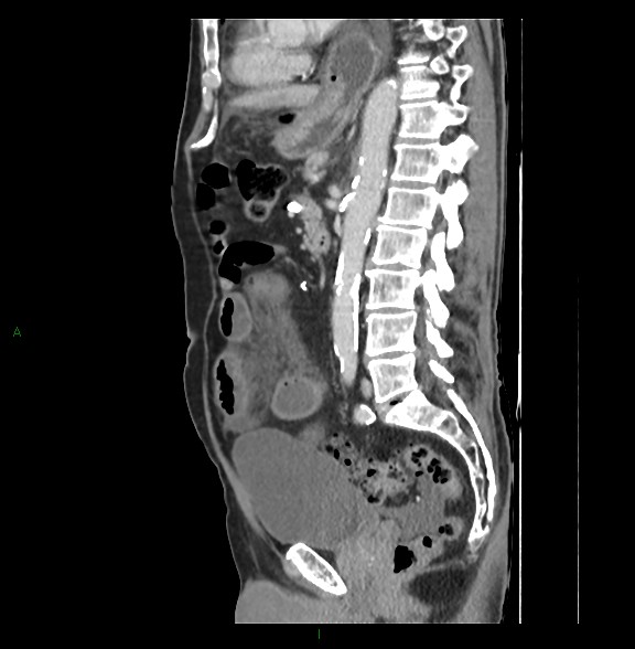 Closed loop small bowel obstruction with ischemia (Radiopaedia 84180-99456 C 51).jpg