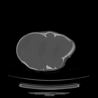 Cloverleaf skull (Radiopaedia 91901-109710 Axial bone window 117).jpg