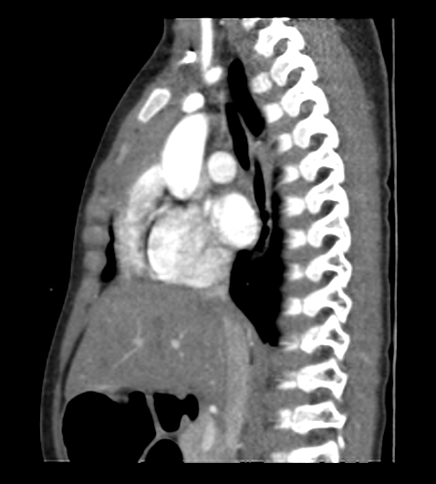 File:Coarctation of aorta (Radiopaedia 27427-27622 Sagittal C+ CTPA 53).png
