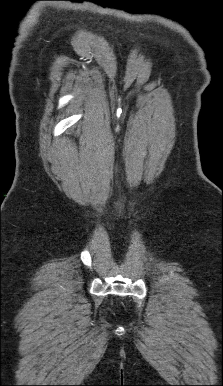 Coarctation of the aorta (Radiopaedia 74632-88521 B 242).jpg