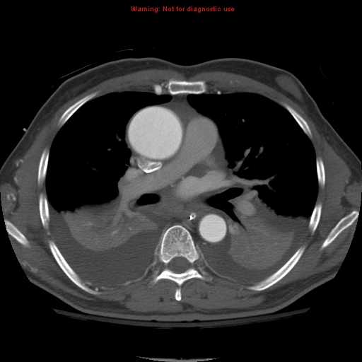 File:Coarctation of the aorta (Radiopaedia 8681-9490 B 32).jpg