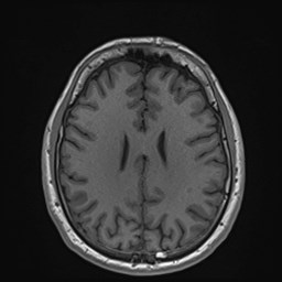 File:Cochlear incomplete partition type III associated with hypothalamic hamartoma (Radiopaedia 88756-105498 Axial T1 129).jpg