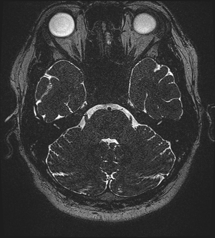 Cochlear incomplete partition type III associated with hypothalamic hamartoma (Radiopaedia 88756-105498 Axial T2 92).jpg