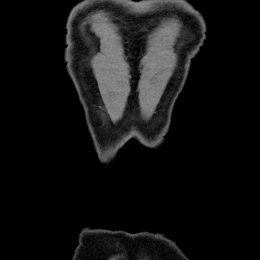 File:Codominant double aortic arch (Radiopaedia 56012-62637 B 50).jpg