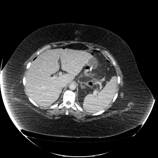 File:Collection due to leak after sleeve gastrectomy (Radiopaedia 55504-61972 A 23).jpg