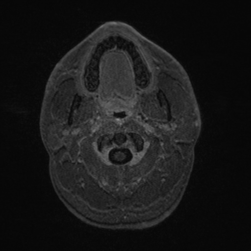 Colloid cyst (Radiopaedia 44510-48181 Axial T1 C+ 8).png