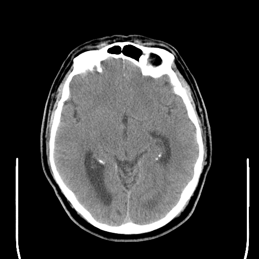 File:Colloid cyst (large) (Radiopaedia 34415-35734 Axial non-contrast 26).png
