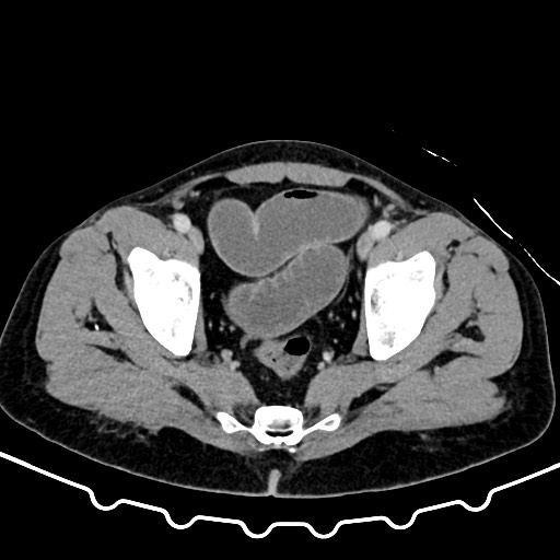 File:Colocolic intussusception due to large lipoma (Radiopaedia 68773-78482 A 170).jpg