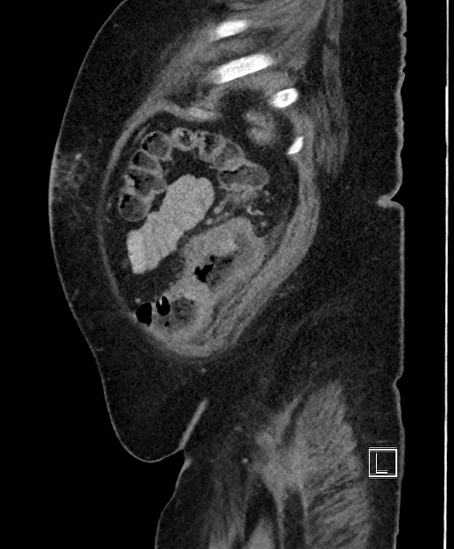 Colon adenocarcinoma (Radiopaedia 59374-66735 C 12).jpg