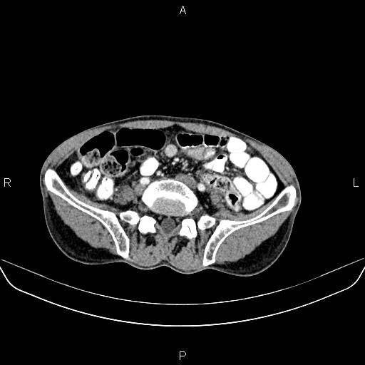 Colon adenocarcinoma - hepatic flexure (Radiopaedia 85635-101395 A 64).jpg