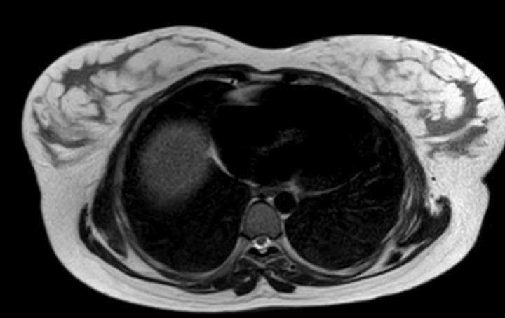Colon adenocarcinoma with Krukenberg tumors, advanced pregnancy (Radiopaedia 67279-76645 Axial T2 83).jpg