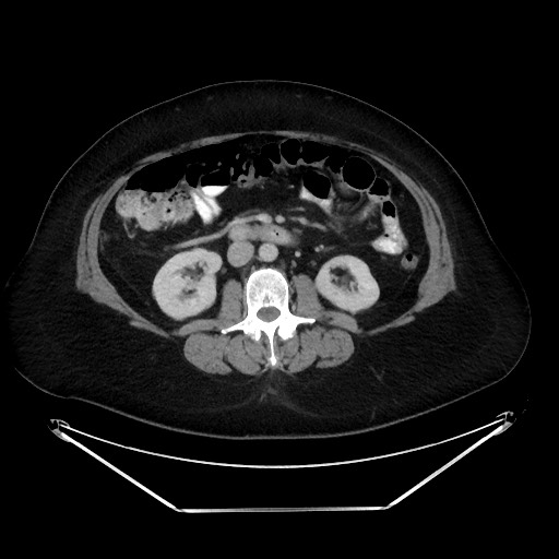File:Colonic intussusception due to adenocarcinoma (Radiopaedia 86828-102987 A 71).jpg