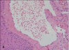 Intraluminal papillary projection and hobnail endothelial cells lining superficial dilated vessels (H&E, ×400)
