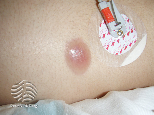 File:Leukaemia cutis (DermNet NZ dermal-infiltrative-leukaemia-cutis1).jpg