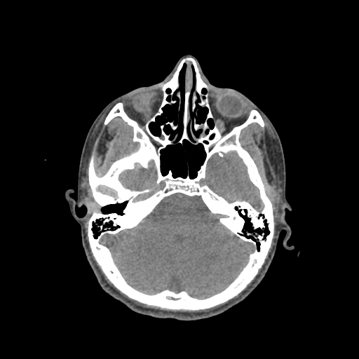 Nasal pyogenic granuloma (lobular capillary hemangioma) (Radiopaedia 85536-101244 Axial non-contrast 86).jpg
