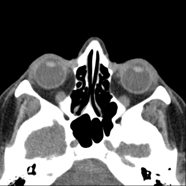 Nasolabial cyst (Radiopaedia 33987-35205 Axial non-contrast 30).jpg