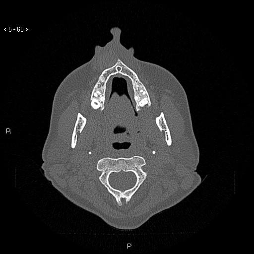 Nasolabial cyst (Radiopaedia 75125-86194 Axial bone window 26).jpg
