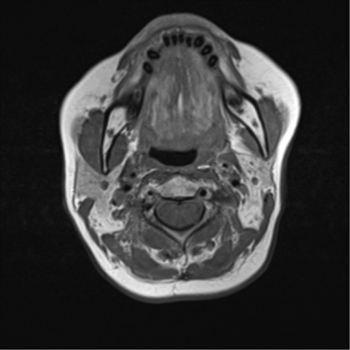File:Nasopharyngeal carcinoma with cerebral abscess (Radiopaedia 43018-46273 Axial T1 27).png