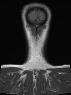 File:Nasopharyngeal carcinoma with perineural spread (Radiopaedia 55030-61380 Coronal T1 26).jpg