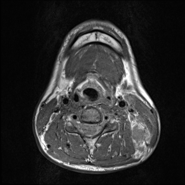File:Nasopharyngeal carcinoma with skull base invasion (Radiopaedia 53415-59485 Axial T1 52).jpg