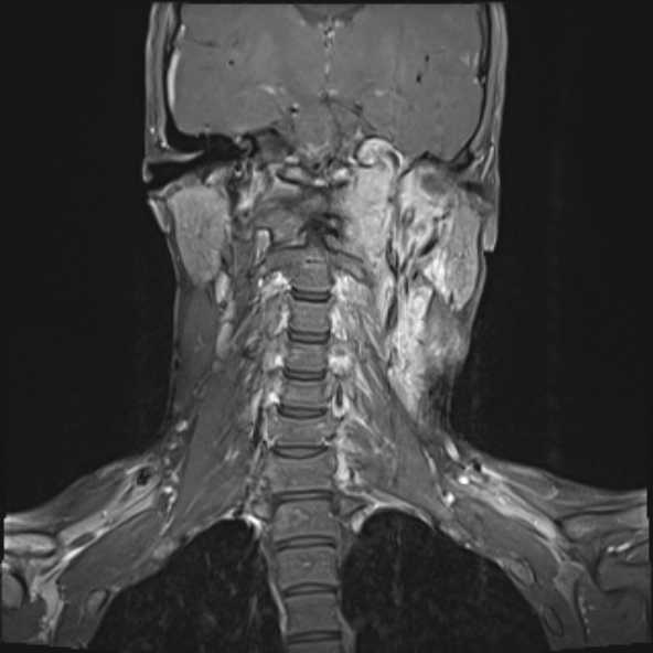 Nasopharyngeal carcinoma with skull base invasion (Radiopaedia 53415-59485 E 14).jpg