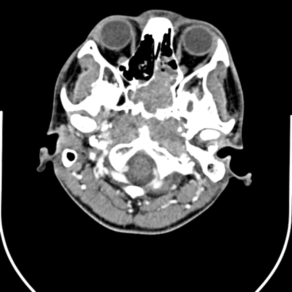 File:Nasopharyngeal carcinoma with skull base invasion (Radiopaedia 53415-59705 A 28).jpg