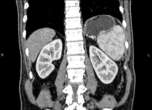 Necrotizing pancreatitis (Radiopaedia 87796-104248 F 52).jpg