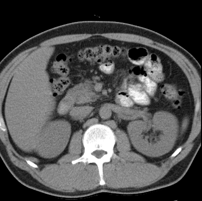 File:Necrotizing pancreatitis with acute necrotic collection (Radiopaedia 14470-14417 Axial non-contrast 16).jpg