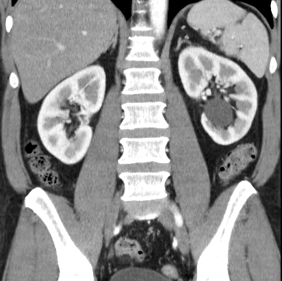 File:Necrotizing pancreatitis with acute necrotic collection (Radiopaedia 14470-14417 C 29).jpg