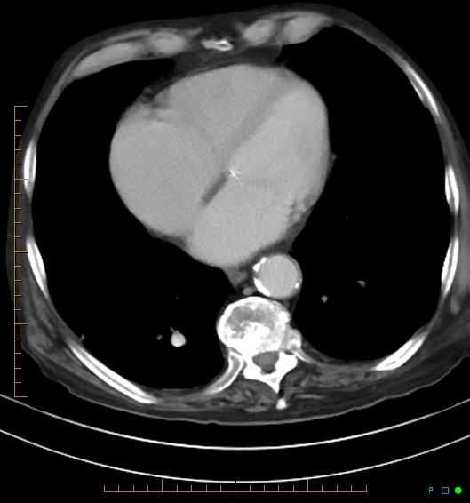 Necrotzing fasciitis due to a perforated adenocarcinoma of the splenic flexure (Radiopaedia 46930-51455 A 11).jpg