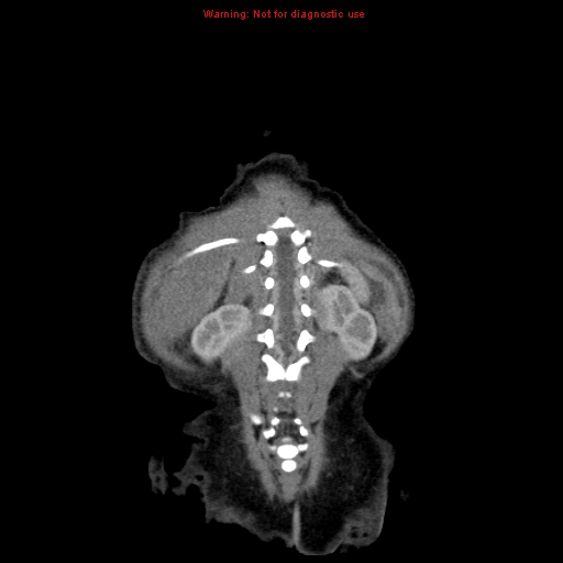 File:Neonatal neuroblastoma (Radiopaedia 9564-10223 B 103).jpg