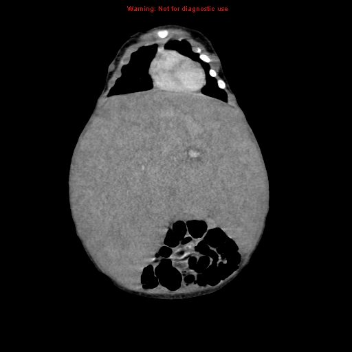File:Neonatal neuroblastoma (Radiopaedia 9564-10223 B 38).jpg