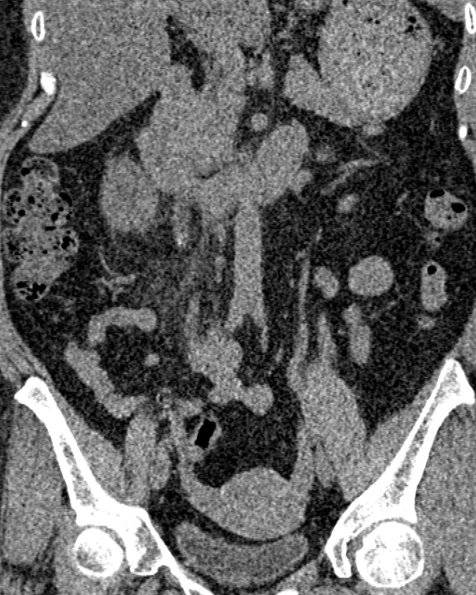 File:Nephrostomy for urosepsis (Radiopaedia 26180-26330 non-contrast 44).jpg