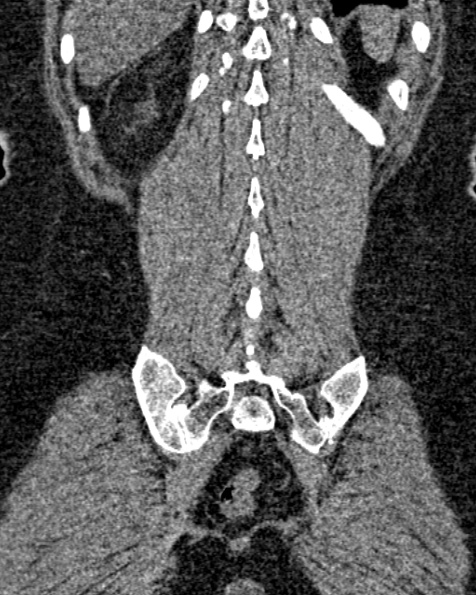 File:Nephrostomy for urosepsis (Radiopaedia 26180-26330 non-contrast 74).jpg