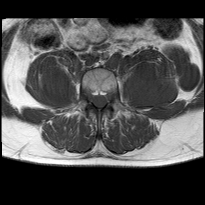 File:Neurofibromatosis type 1- extensive spinal involvement and Christmas tree sign (Radiopaedia 60610-68332 Axial T1 20).jpg