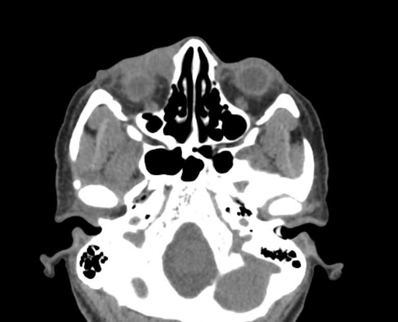 Neurofibromatosis type 1- orbital manifestations (Radiopaedia 49391-54511 Axial non-contrast 38).jpg