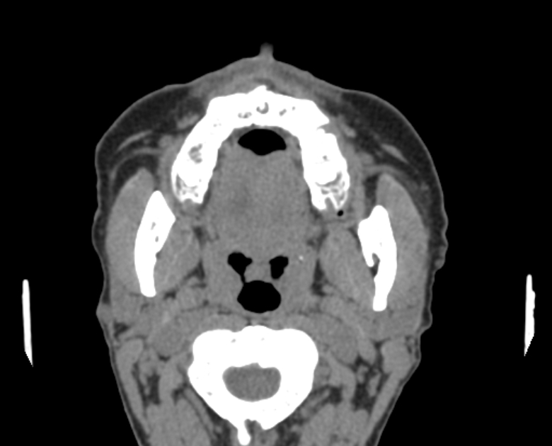 Neurofibromatosis type 1- orbital manifestations (Radiopaedia 49391-54511 Axial non-contrast 6).jpg