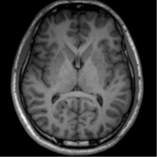 File:Neurofibromatosis type 2 (Radiopaedia 44936-48838 Axial T1 76).png