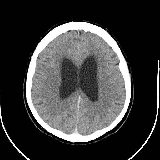 Neurofibromatosis type 2 (Radiopaedia 79097-92047 Axial non-contrast 40).jpg