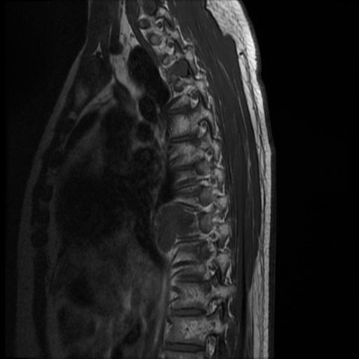 File:Neurofibromatosis type 2 (spinal manifestations) (Radiopaedia 53943-60070 D 11).png