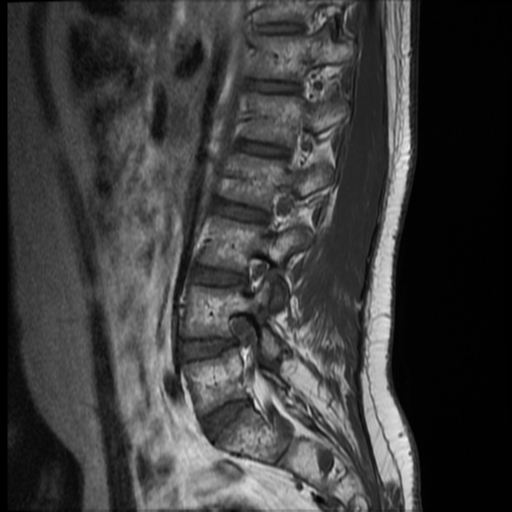 File:Neurofibromatosis type 2 (spinal manifestations) (Radiopaedia 53943-60070 F 11).png