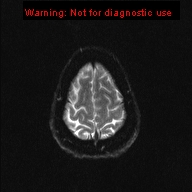 File:Neuroglial cyst (Radiopaedia 10713-11184 Axial DWI 3).jpg
