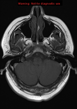 File:Neuroglial cyst (Radiopaedia 10713-11184 Axial T1 19).jpg