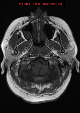 File:Neuroglial cyst (Radiopaedia 10713-11184 Axial T1 21).jpg